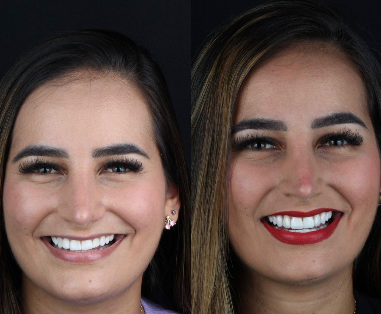 Transformação de Sorriso 2