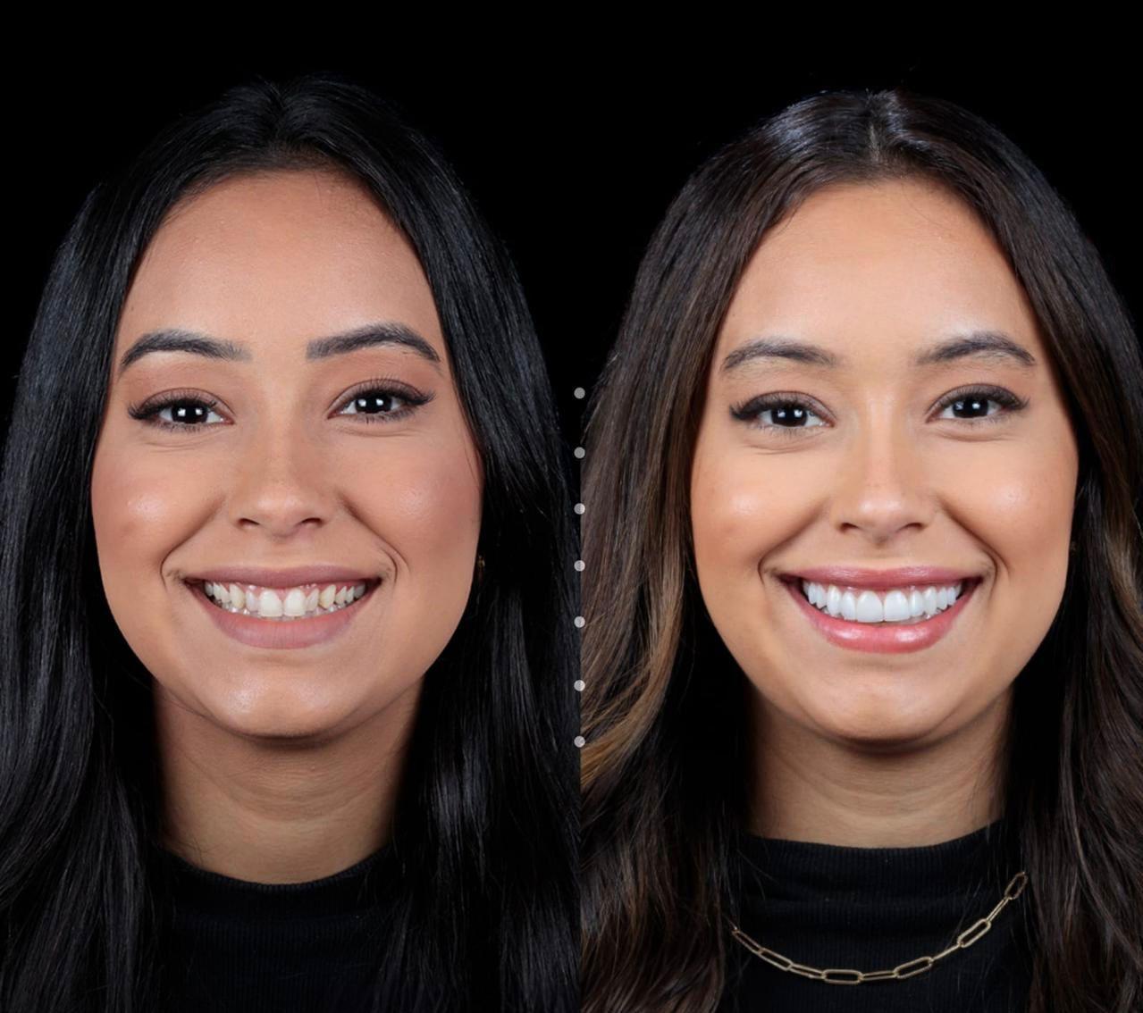 Transformação de Sorriso 3