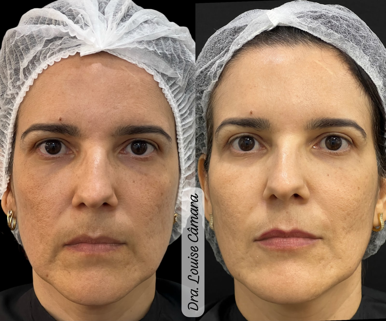 Antes e Depois Harmonização Facial 1