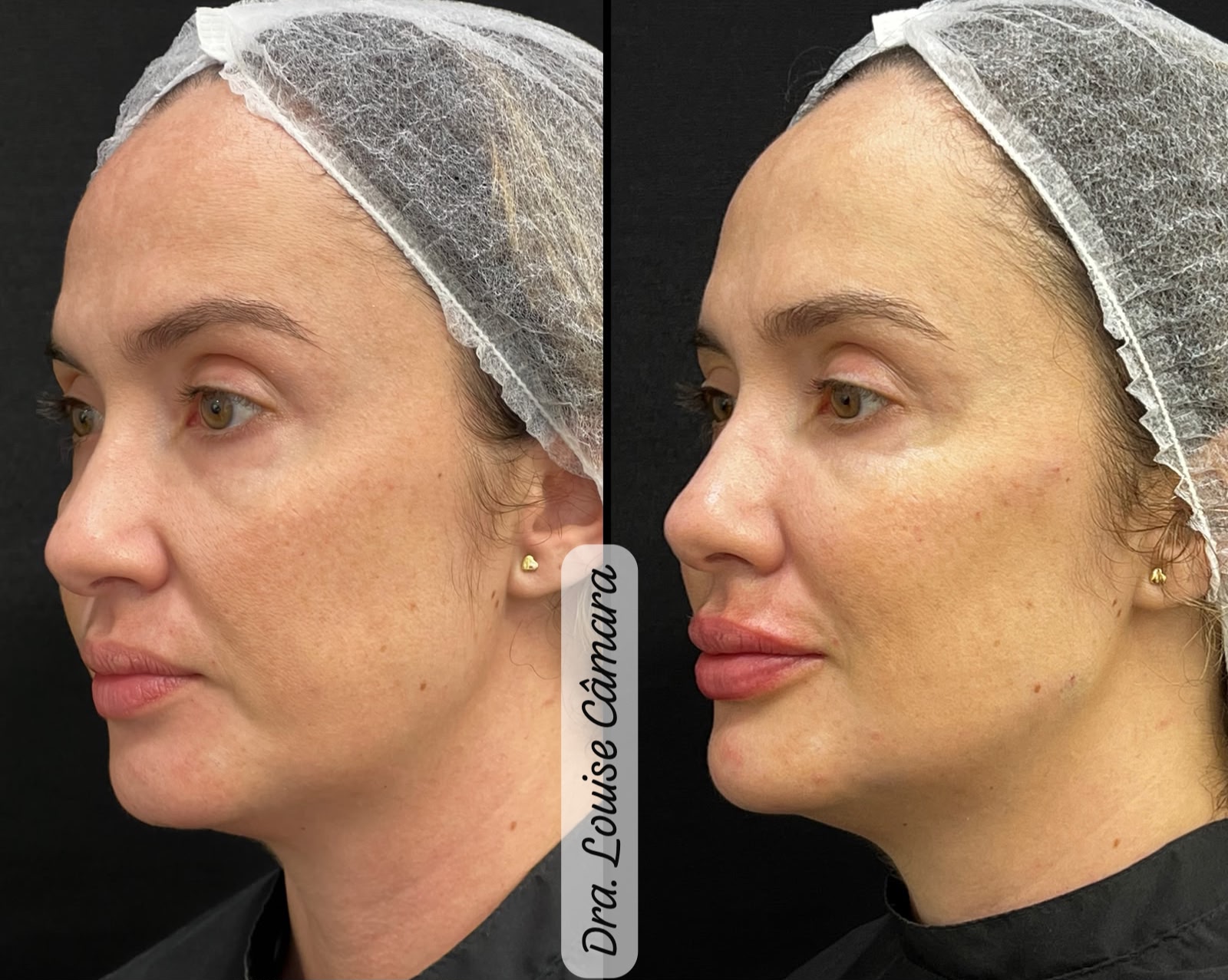 Antes e Depois Harmonização Facial 2